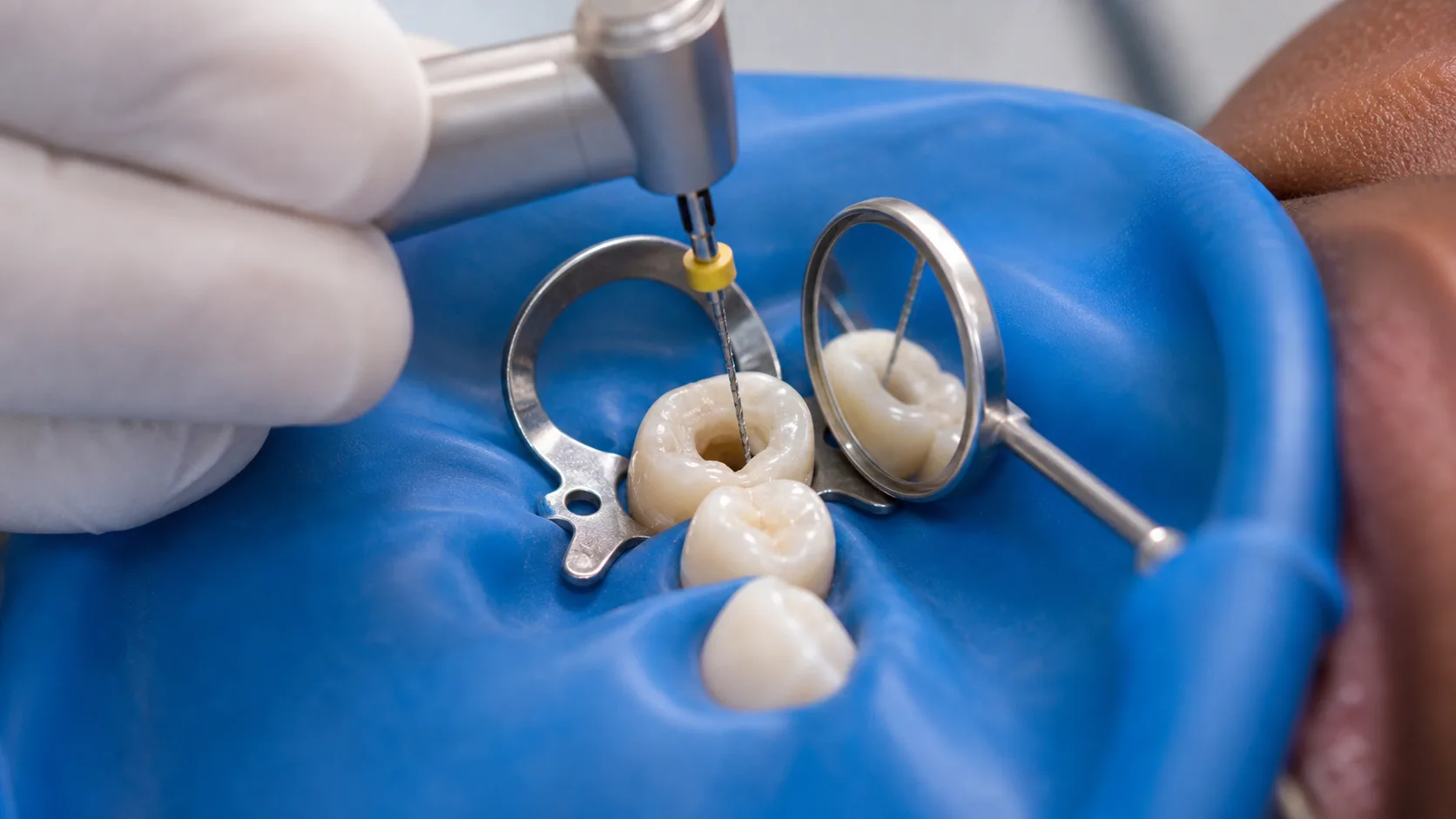 Root Canal Treatment