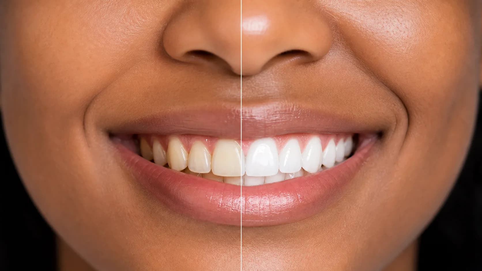 Teeth Whitening