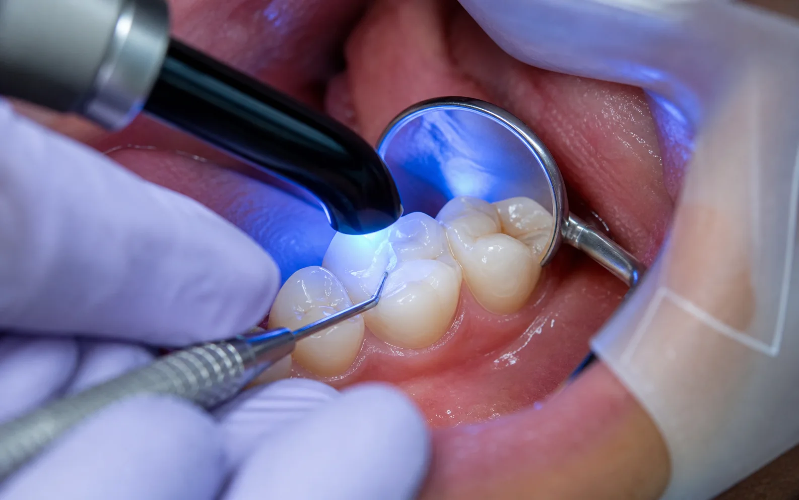 Fillings educational visual