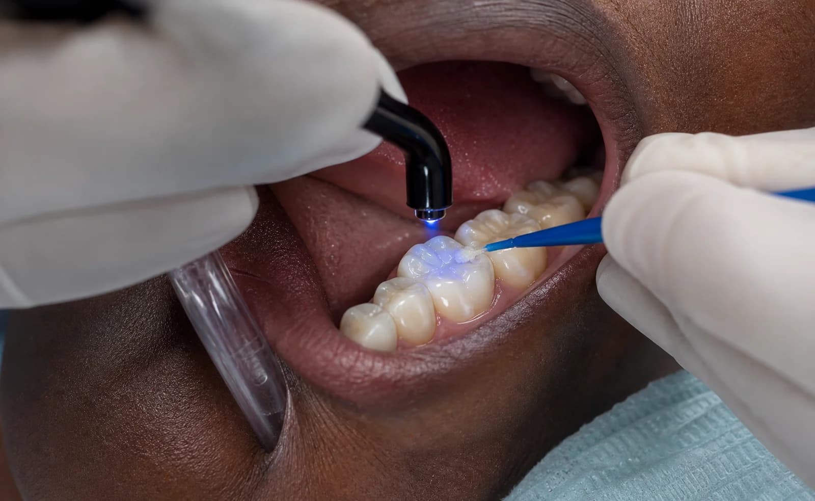 Fissure Sealants